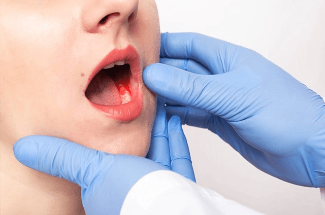 ओरल कैंसर क्या है? कारण, लक्षण और बचाव की जानकारी